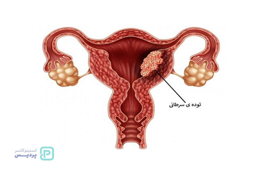 سرطان دهانه رحم چیست؟